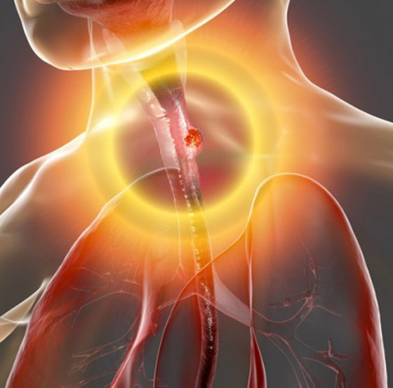 خمسة أعراض شائعة للسرطان نتغاضى عنها صورة رقم 2