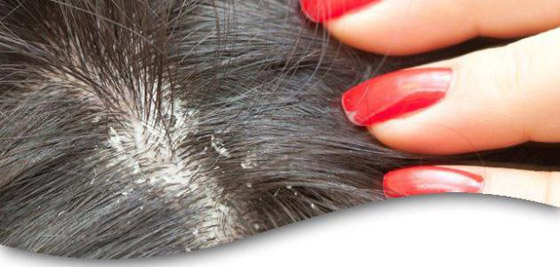 طرق بسيطة للتخلّص من قشرة الرأس صورة رقم 3