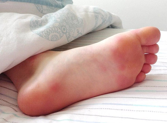 تعرفوا إلى 10 طرق سهلة وبسيطة لتخفيف آلام القدمين والتهاب العظام صورة رقم 6