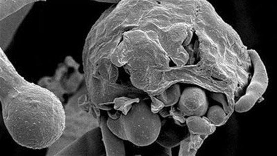 بعد الفطر الأسود، مرض 