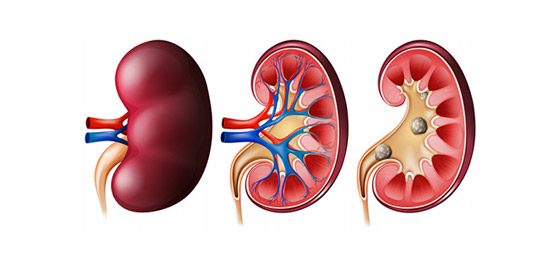 كيف يؤدي فشل الكلى المزمن إلى زيادة خطر الإصابة بأمراض القلب؟ صورة رقم 4