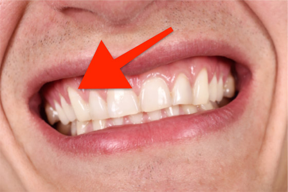 قد تدل على مشكلة صحية خطيرة.. ما أسباب حساسية اللثة وطرق علاجها؟ صورة رقم 7 قد تدل على مشكلة صحية خطيرة.. ما أسباب حساسية اللثة وطرق علاجها؟ صورة رقم 7
