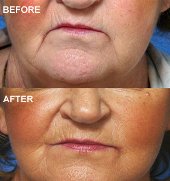 تعديل الأذن لتشبه الجنيات.. إليكم 6 عمليات تجميل مجنونة لم تسمع بها صورة رقم 2