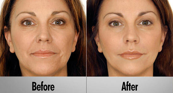 تعديل الأذن لتشبه الجنيات.. إليكم 6 عمليات تجميل مجنونة لم تسمع بها صورة رقم 4