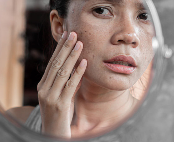 إليكم 5 طرق لتفتيح البقع الداكنة بالوجه والجسم قبل العيد صورة رقم 7