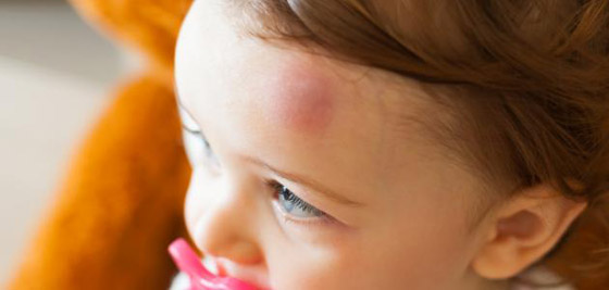 مخاطر سقوط الطفل على رأسه صورة رقم 2