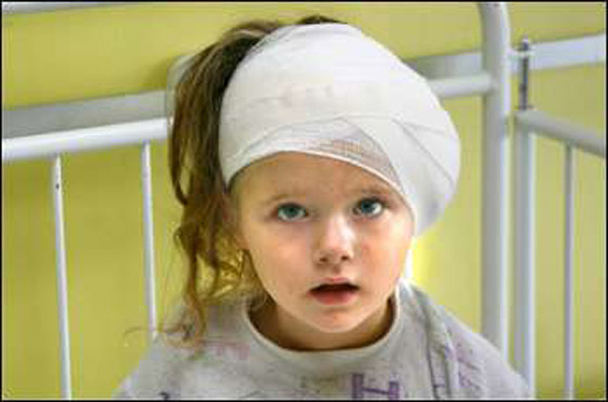 مخاطر سقوط الطفل على رأسه صورة رقم 3