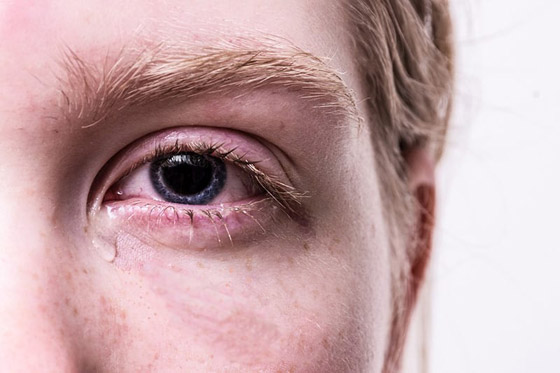 4 أسباب لتساقط الدموع اللاإرادي صورة رقم 4