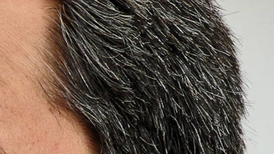 هل يسبب التوتر تحول لون الشعر إلى الرمادي؟ صورة رقم 5