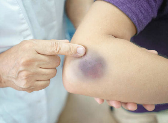 تعاني من الكدمات الزرقاء باستمرار ولا تتذكر السبب؟ قد يشير لحالات صحية خطيرة صورة رقم 5