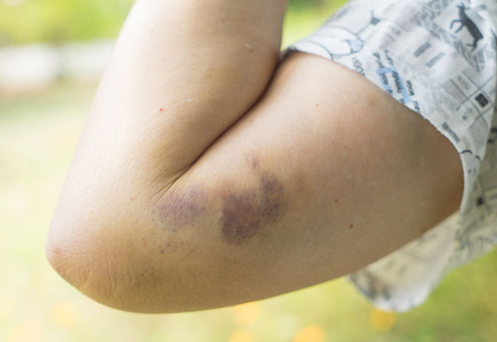 تعاني من الكدمات الزرقاء باستمرار ولا تتذكر السبب؟ قد يشير لحالات صحية خطيرة صورة رقم 6