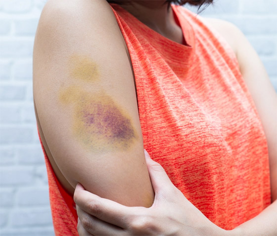 تعاني من الكدمات الزرقاء باستمرار ولا تتذكر السبب؟ قد يشير لحالات صحية خطيرة صورة رقم 1