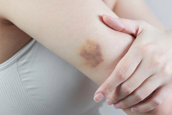 تعاني من الكدمات الزرقاء باستمرار ولا تتذكر السبب؟ قد يشير لحالات صحية خطيرة صورة رقم 2