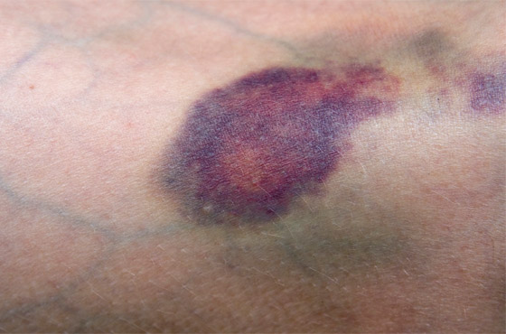 تعاني من الكدمات الزرقاء باستمرار ولا تتذكر السبب؟ قد يشير لحالات صحية خطيرة صورة رقم 3