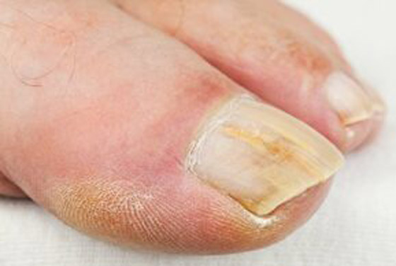 منها الجوارب الملونة.. 5 أسباب وراء رائحة أظافر القدم الكريهة صورة رقم 2