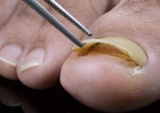 منها الجوارب الملونة.. 5 أسباب وراء رائحة أظافر القدم الكريهة صورة رقم 3