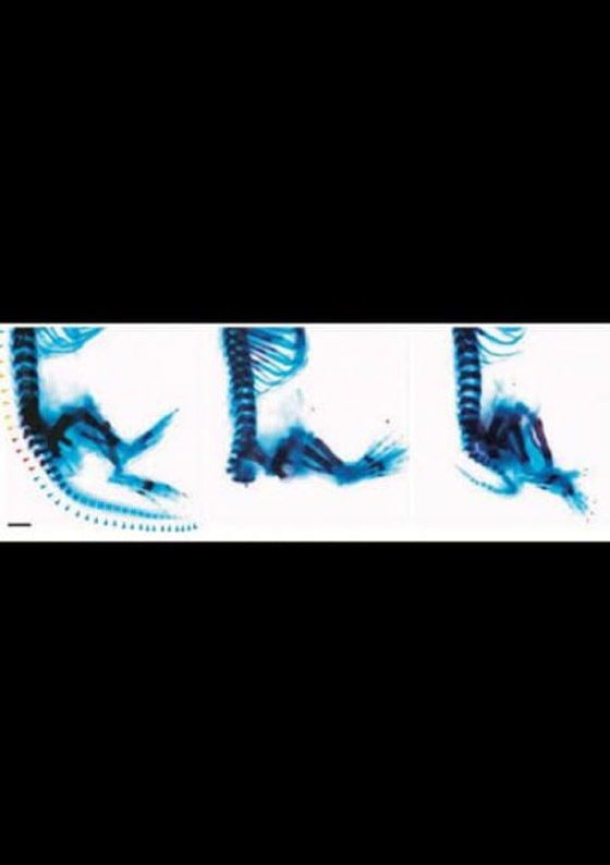 متلازمة زكي