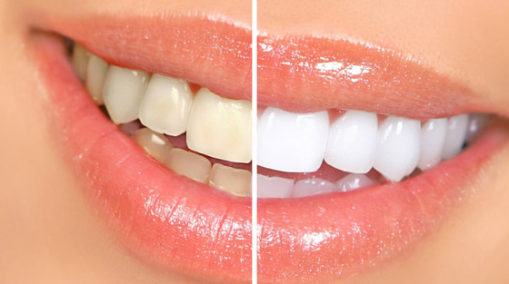 إليكم طرق بسيطة وعلاجات طبيعية تساعدكم على تبييض أسنانكم صورة رقم 1