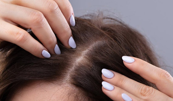 جافة أم دهنية.. أي نوع من القشرة تعانون منه؟ وما علاجها؟ صورة رقم 3