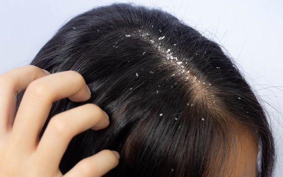 جافة أم دهنية.. أي نوع من القشرة تعانون منه؟ وما علاجها؟ صورة رقم 5