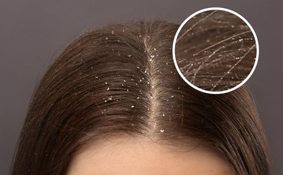 جافة أم دهنية.. أي نوع من القشرة تعانون منه؟ وما علاجها؟ صورة رقم 1