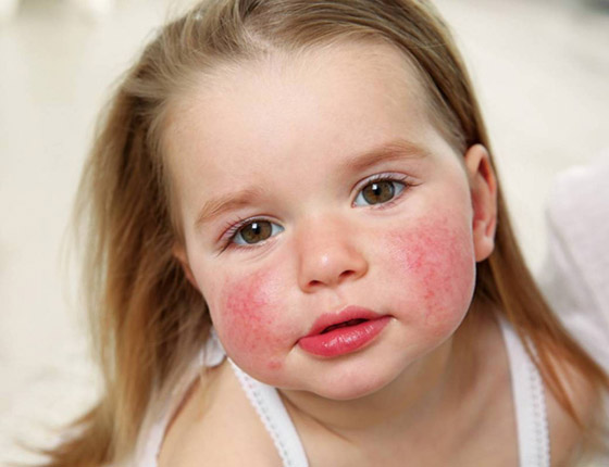 حساسية الأمعاء على الغلوتين: تجنبوا هذه الأطعمة! صورة رقم 2