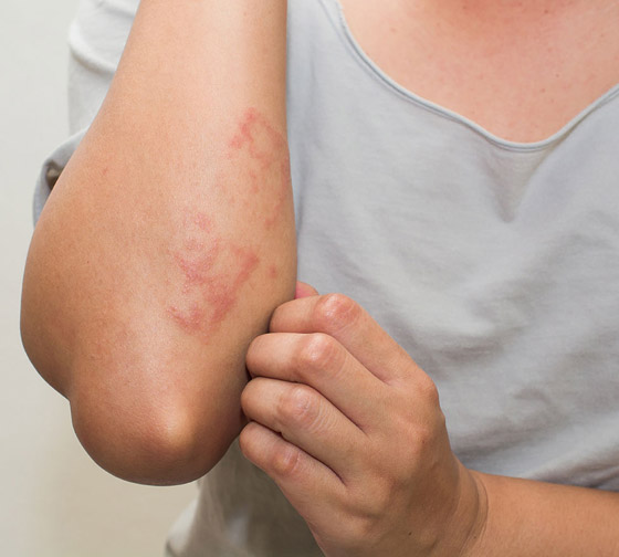 حساسية الأمعاء على الغلوتين: تجنبوا هذه الأطعمة! صورة رقم 8