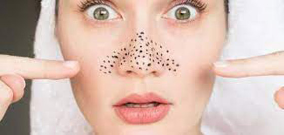 لهذه الأسباب.. لا تستخدمي لاصقات الأنف لإزالة الرؤوس السوداء صورة رقم 4