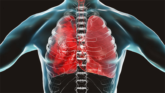 صور بالأشعة السينية تظهر الفرق بين الرئتين قبل وبعد اللقاح صورة رقم 4