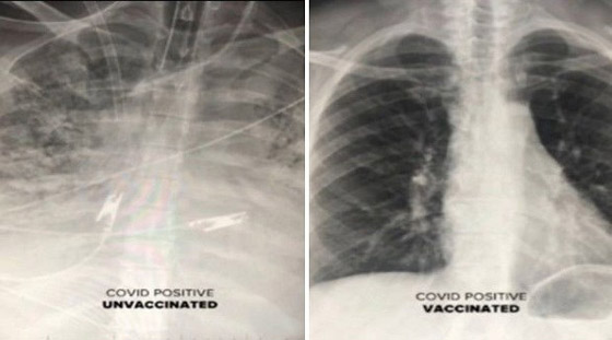 صور بالأشعة السينية تظهر الفرق بين الرئتين قبل وبعد اللقاح صورة رقم 3