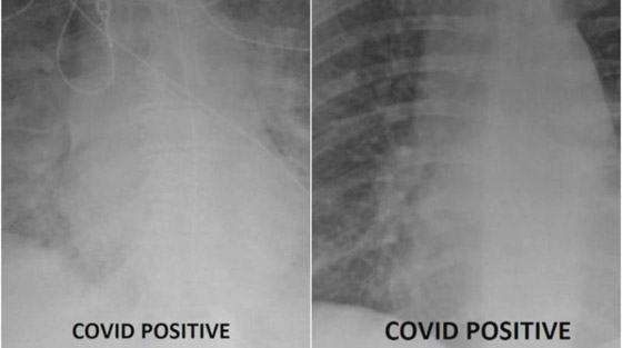 صور بالأشعة السينية تظهر الفرق بين الرئتين قبل وبعد اللقاح صورة رقم 6