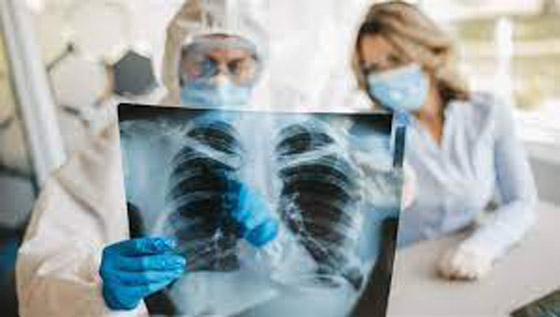 صور بالأشعة السينية تظهر الفرق بين الرئتين قبل وبعد اللقاح صورة رقم 2