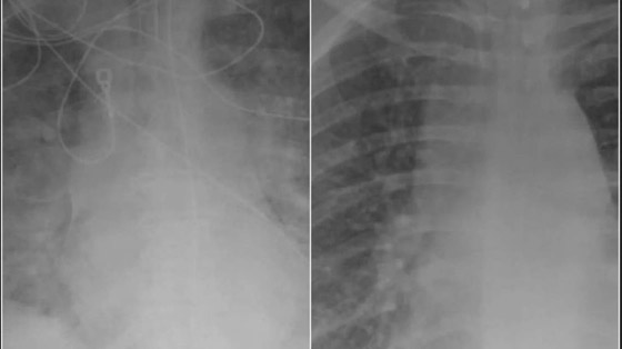 صور بالأشعة السينية تظهر الفرق بين الرئتين قبل وبعد اللقاح صورة رقم 1