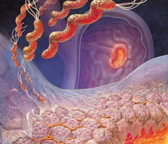 جرثومة المعدة.. أعراضها الصحية والنفسية وعلاجها بالأعشاب صورة رقم 5