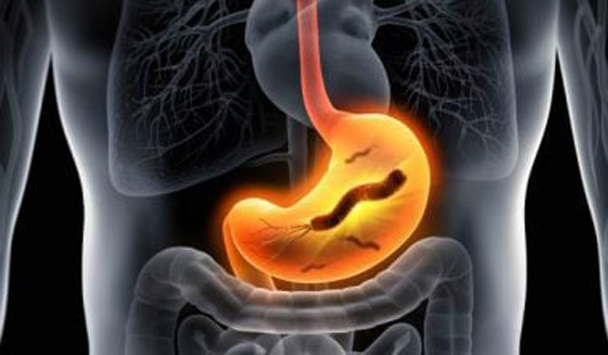 جرثومة المعدة.. أعراضها الصحية والنفسية وعلاجها بالأعشاب صورة رقم 7