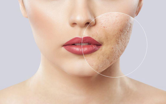 إليكم طرق إزالة حفر الوجه طبيعيا قبل رأس السنة صورة رقم 4