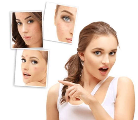 إليكم طرق إزالة حفر الوجه طبيعيا قبل رأس السنة صورة رقم 5