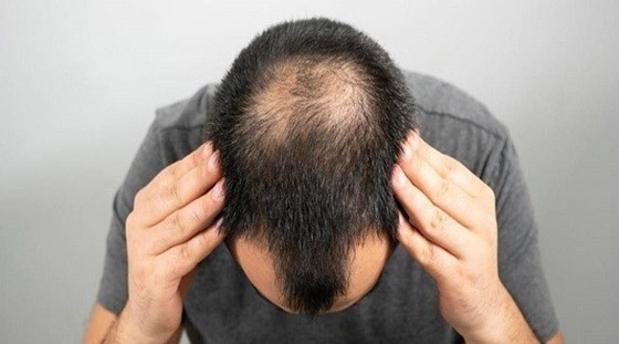 أشياء هامة عليك معرفتها قبل الإقدام على زراعة الشعر صورة رقم 1