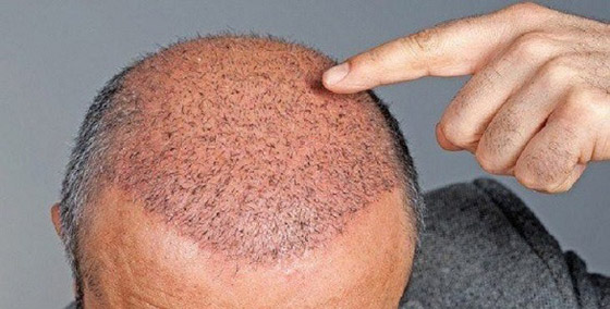 أشياء هامة عليك معرفتها قبل الإقدام على زراعة الشعر صورة رقم 2
