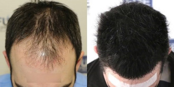 أشياء هامة عليك معرفتها قبل الإقدام على زراعة الشعر صورة رقم 3