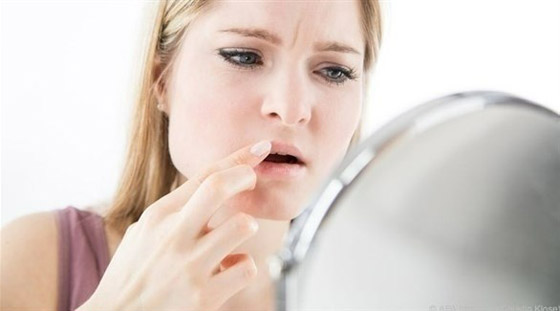 تشقق زوايا الفم...أكبر من مجرد مشكلة جمالية صورة رقم 1