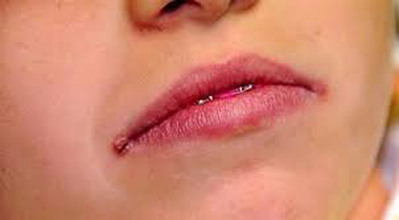 تشقق زوايا الفم...أكبر من مجرد مشكلة جمالية صورة رقم 3