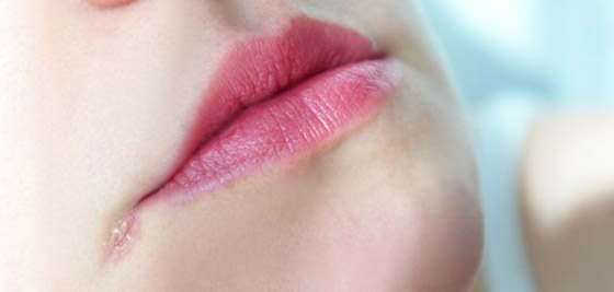 تشقق زوايا الفم...أكبر من مجرد مشكلة جمالية صورة رقم 5