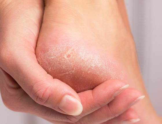 إليكم أفضل 5 علاجات منزلية للتخلص من مشكلة جفاف وتقشر القدمين صورة رقم 3 إليكم أفضل 5 علاجات منزلية للتخلص من مشكلة جفاف وتقشر القدمين صورة رقم 3