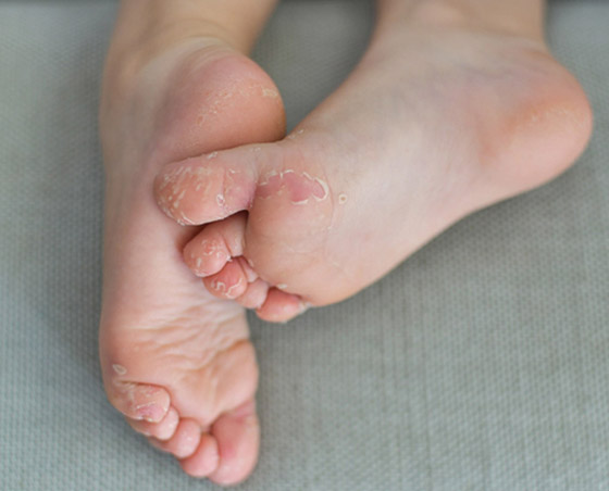 إليكم أفضل 5 علاجات منزلية للتخلص من مشكلة جفاف وتقشر القدمين صورة رقم 6 إليكم أفضل 5 علاجات منزلية للتخلص من مشكلة جفاف وتقشر القدمين صورة رقم 6