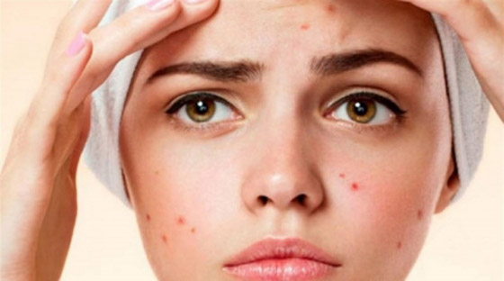 لبشرة خالية من حب الشباب.. تجنبوا تناول هذه الأطعمة صورة رقم 2