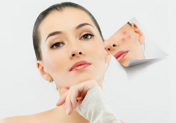 ماسك القرفة واللبن لعلاج حب الشباب والتخلص من حفر الوجه صورة رقم 9