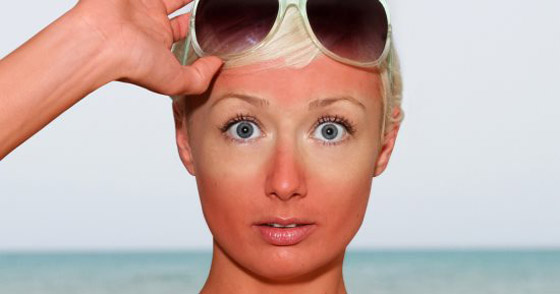 هل يمكن تجنب ظهور الطفح الشمسي على البشرة؟ صورة رقم 2