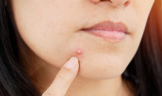 منها معجون الأسنان والملح.. 10 طرق للتخلص من بثور البشرة المفاجئة صورة رقم 2