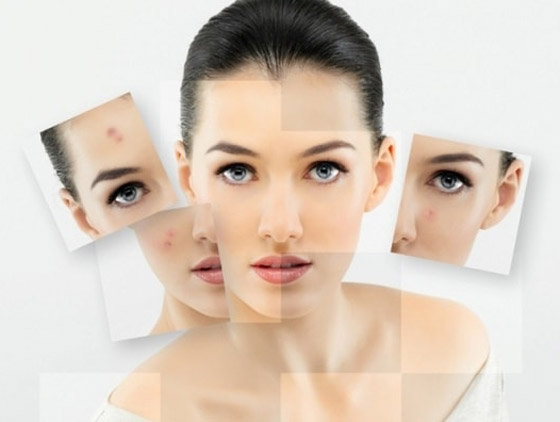 منها معجون الأسنان والملح.. 10 طرق للتخلص من بثور البشرة المفاجئة صورة رقم 5